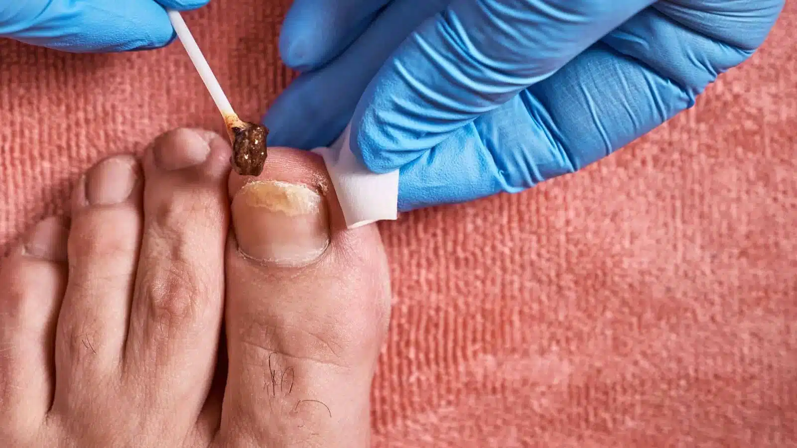 cuidado-de-uñas-con-hongo